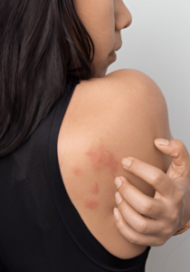 Les punaises de lit  pourquoi sen debarrasser 